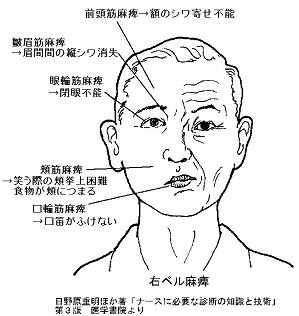 顔面神経麻痺（症状）