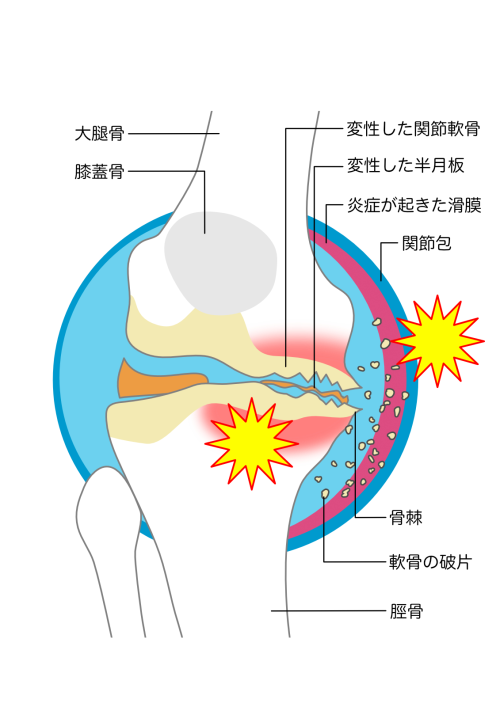変形性膝関節症（解剖図）