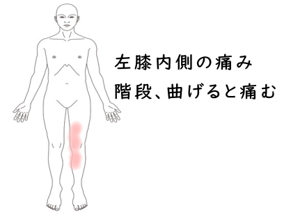 変形性膝関節症の症例
