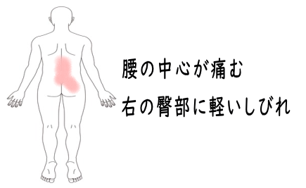 椎間関節性腰痛の症例