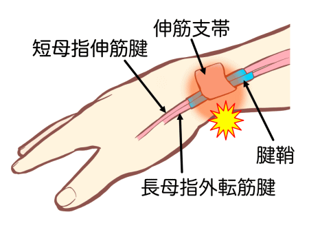 腱鞘炎