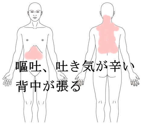 吐き気、嘔吐が辛い妊婦さんの（症例）