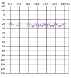 オージオグラム（正常）